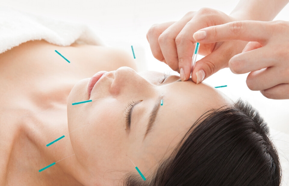 美容鍼